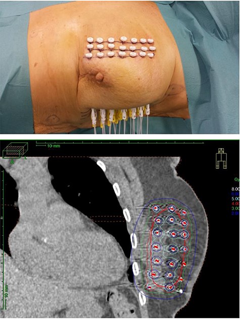 Multicatheter interstitial brachytherapy: implanted applicators (upper picture) and dose distribution (lower picture).