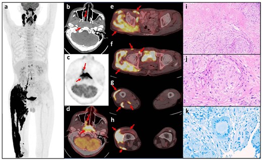 (a) Maximum intensity projection of FDG PET; (b–d) axial PET/CT showing nasopharyngeal carcinoma invading the skull base; (e–h) axial PET/CT showing hypermetabolic lymph nodes in the right groin and unevenly elevated metabolism in the thigh muscles; (i–j) HE staining showed coagulative necrosis surrounded by granulomatous inflammation, mainly composed of epithelioid cells (i, ×200) and a few lymphocytes (j, ×400); (k) acid-fast staining revealed multinucleated giant cells.