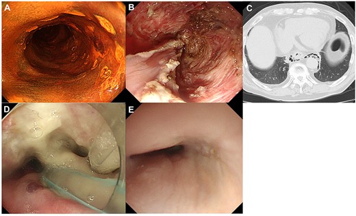 Clinical course of a patient who was detected delayed perforation after ESD. A: Local recurrent lesion after CRT, Type 0-IIc located in the right wall of the middle thoracic esophagus; B: During ESD, severe fibrosis in the submucosal layer was observed; C: After ESD, a delayed perforation was occurred. The presence of mediastinal emphysema was observed on computed tomography; D: This patient required a continual drainage of saliva at the perforation site through a nasal tube; E: The closure of the perforation was confirmed by endoscopic observation and esophagography.