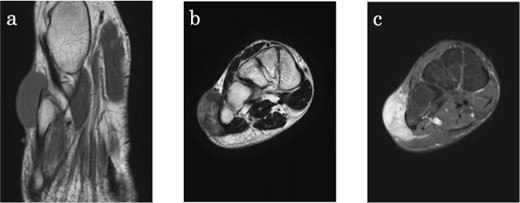 Clear cell sarcoma on the lateral aspect of the right foot in a 34-year-old male. (a) Axial T1-weighted magnetic resonance (MR) image shows a lesion with slightly higher signal intensity compared with skeletal muscle. (b) Coronal T2-weighted MR image shows the tumour with high signal intensity, adjacent to the bone, and extending into the subcutis. (c) On T1-fat suppressed coronall MR image, the lesion is homogenously enhanced with gadolinium.
