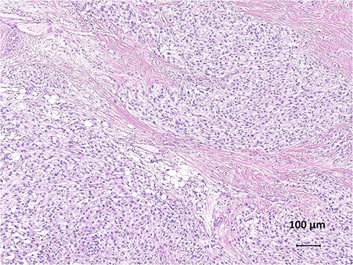 Histological findings of clear cell sarcoma. Tumour cells with abundant cytoplasm and prominent nucleoli are separated into nests by fibrous septa (haematoxylin and eosin, ×100).