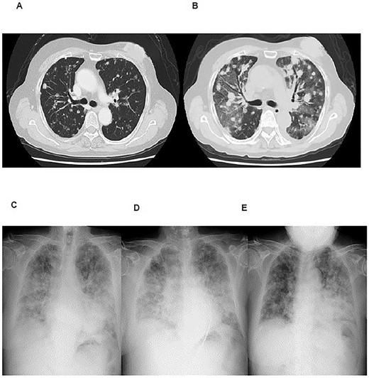 Imaging studies of case 3. Chest CT scans at 1 year before (A) and at onset (B) of ILD (organizing pneumonia). Chest X-rays at the onset of ILD (C), after mPSL pulse therapy (D), and after cyclophosphamide and second mPSL pulse therapy (E).