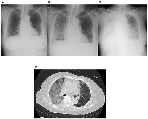 Imaging studies of case 4. Chest X-rays 1 week before (A), at (B), and 3 days after (C) the onset of ILD. Chest CT scan at the onset of ILD (D).