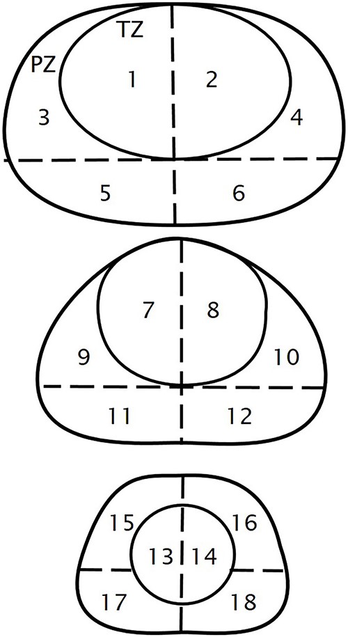 Prostatic segments three axial planes (basal, midgland, and apex) of the prostate are selected and divided into 18 segments: TZ, transitional zone; PZ, peripheral zone.