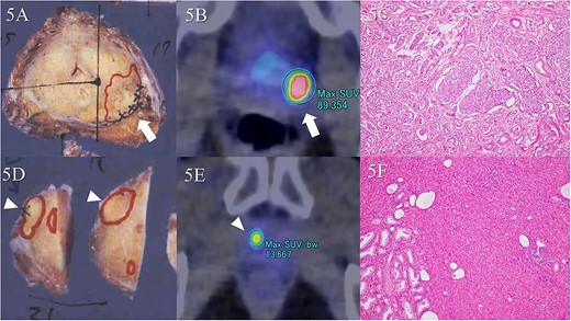 Comparison of pathologic specimens and 18F-PSMA 1007 PET/CT. There were two tumor foci in separate segments. Tumor lesion is in the left dorsal segment of the midgland on macroscopic observation (A, arrow). The largest diameter is 20 mm. A Gleason score of 4 + 3 demonstrates significant uptake (B, arrow). Microscopic observation reveals adenocarcinoma with Gleason score of 4 + 3 (C). In addition, the diameter of the tumor in the right ventral segment of the apex is a maximal 18 mm (D, arrowhead). Significant uptake is found in the corresponding area on 18F-PSMA 1007 PET/CT (E, arrowhead). Gleason score is 4 + 3, similarly (F).