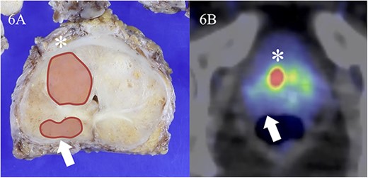 False negative finding identified on 18F-PSMA 1007 PET/CT. Tumor lesion is in the right ventral segment of the midgland on macroscopic observation (A, asterisk). The largest diameter is 18 mm and Gleason score is 3 + 3. Significant uptake is found in the same area on 18F-PSMA 1007 PET/CT (B, asterisk). The SUVmax is 44.2. In contrast, tumor in the right dorsal segment of the midgland (FA, arrow) representing maximal 10 mm and Gleason score 3 + 4 can’t be detected on 18F-PSMA 1007 PET/CT (B, arrow).