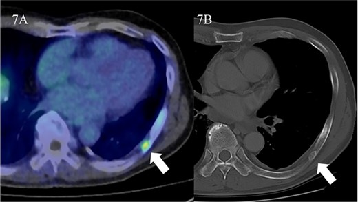 False positive finding resulted from a benign rib tumor. Focal uptake is identified in the left rib on 18F-PSMA 1007 PET/CT (A, arrow). The SUVmax is 2.8. Corresponded CT showed an osteolytic but slightly sclerotic rim lesion. No significant change was found in CT appearance of rib lesion for 3 years (B, arrow). This patient was diagnosed as having recurrent tumor within prostate after IMRT.