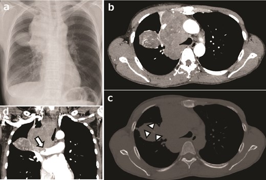 NTRK-positive sarcoma of the right anteromediasternum in a 48-year-old woman. (a) Chest radiograph showing a mass lesion in the upper right chest area, expanding from the mediasternum. (b) Contrast-enhanced computed tomography (CT) image showing a lobular lesion with heterogeneously enhanced signals, highly vascularized intra- and peritumoral areas, without apparent necrosis or hemorrhage. (c) Bone window plain CT image showing a slightly calcified area (marks). (d) Coronal plane CT image showing tumor invasion into the right pulmonary artery (arrow).