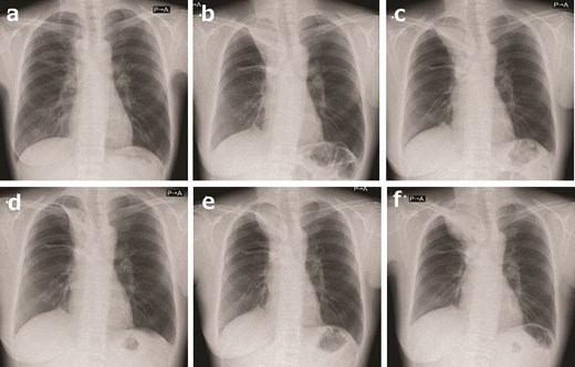 A 48-year-old woman with an NTRK-positive sarcoma in the right anteromediasternum was treated with a TRK inhibitor. (a) After conventional chemotherapy consisting of vincristine, doxorubicin, and cyclophosphamide alternating with ifosfamide and etoposide (VDC/IE) combined with radiotherapy, the tumor had shrunk immensely. (b) Although conventional chemotherapy was continued, the tumor began to grow. In ~2 years, the tumor was much larger. This occurrence allowed for the crucial opportunity to perform a second biopsy, during which the NTRK fusion was finally identified; the patient commenced entrectinib. (c) After 5 months, the tumor began to regrow. The patient commenced larotrectinib. (d) After 1 month, larotrectinib shrunk the tumor a little. (e) After 1 year of larotrectinib, the tumor grew slightly. (f) After 2 years and 8 months of larotrectinib, the tumor progressed, and the patient stopped taking larotrectinib.