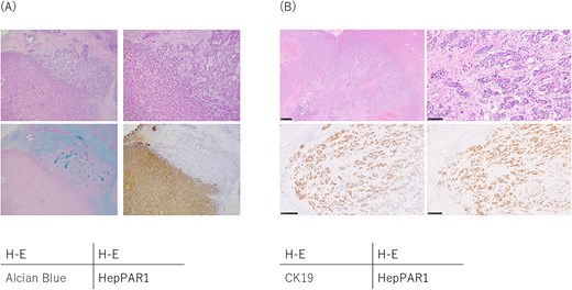 Pathological findings of combined hepatocellular-cholangiocarcinoma. (A) Classical type. The upper right area shows the cholangiocarcinoma component and the lower left area shows the hepatocellular carcinoma component, and these components are mixed in this tumor and cannot be separated into distinct regions. Immunohistochemical staining revealed that the cholangiocarcinoma components were positive for Alcian blue and CK19 (not shown) staining, whereas the hepatocellular carcinoma component were positive for and HepPAR1 staining. (B) Intermediate cell carcinoma. Intermediate cell carcinoma is composed of cells that exhibit characteristics of both hepatocellular carcinoma and cholangiocarcinoma. Immunohistochemical staining revealed these tumor cells were positive for both CK19 and HepPAR1.