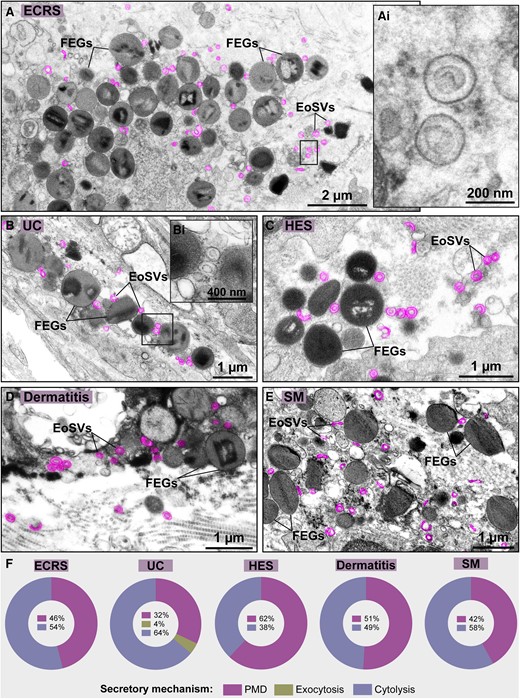 Extracellular sombrero vesicles are frequently observed in tissue sites of eosinophilic cytolytic inflammation. (A–E) Representative electron micrographs of (A) ECRS (nasal sinus), (B) UC (intestines), (C) HES (skin), (D) dermatitis (skin), and (E) SM (rectum) show deposition of FEGs and EoSVs (colored in pink) in the inflamed tissues. Boxed areas in (Ai and Bi) show higher magnifications of EoSVs depicting typical morphology. (F) Quantitative analyses of 166,900 µm2 of tissue area of biopsy samples demonstrated the predominance or high incidence of cytolysis in the eosinophil-associated conditions. Samples were prepared for TEM.
