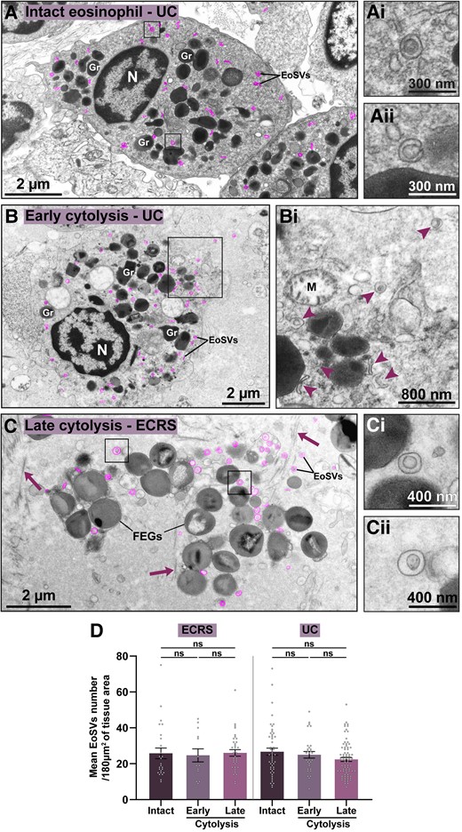 Free EoSVs persist in inflamed tissues after eosinophil cytolysis. (A–C) Representative electron micrographs showing eosinophils as intact (A) or in process of early (B) or late (C) cytolysis, as described in Materials and methods. The intact eosinophil shows secretory granules (Gr) with evidence of piecemeal degranulation (granule enlargement, core disarrangement, and mobilization).50 Cytoplasmic EoSVs (colored in pink) with typical morphology are shown (boxes) in higher magnification in (Ai and Aii). (B) Early cytolytic eosinophil displaying partial plasma membrane breakup (boxed area). Cytoplasmic and released forms of EoSVs are indicated (arrowheads) in (Bi). Note a collapsing mitochondrion (M). (C) Membrane-bound FEGs and free EoSVs (pink, boxed areas in Ci and Cii) are seen in the extracellular matrix after the complete disintegration of the plasma membrane and other organelles. Arrows indicate collagen fibrils. (D) The density of the EoSV population did not change when associated with intact or cytolytic eosinophils. Quantitative analyses were performed in biopsy samples from ECRS (nasal sinus) and UC (intestine) prepared for TEM. A total of 238 tissue areas (each of them with 180 μm2) were analyzed (78 from ECRS and 160 from UC). A total of 6,026 EoSVs were counted (n = 2,142 for ECRS and n = 3,884 for UC). Results are expressed as mean ± SEM (ns, not significant, P > 0.05). N, nucleus.