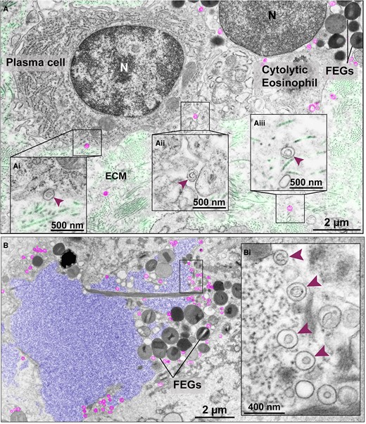 Extracellular EoSVs in tissue sites of cytolytic eosinophilic inflammation. (A) Intact EoSVs (colored in pink) are seen around a cytolytic eosinophil with FEGs, on the surface (Ai and Aii, arrowheads) of a plasma cell and dispersed in the extracellular matrix (ECM) (Aiii, arrowhead). (Ai–Aiii) are higher magnifications of the boxed areas. Longitudinal and cross sections of collagen fibrils from the ECM were colored in light green. In (B), a typical late EETosis area showing highly decondensed and released chromatin (colored in purple), which is the appearance of ETs as seen in thin sections.18 Note intermingled FEGs and intact extracellular sombreros (pink) seen in higher magnification in (Bi) (arrowheads). The electron micrographs were taken from ulcerative colitis/intestine (A) and ECRS/nasal sinus (B) biopsy samples prepared for TEM. N, nucleus.