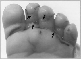 Infant's foot infested with 24 second-instar sarcophagid larvae.