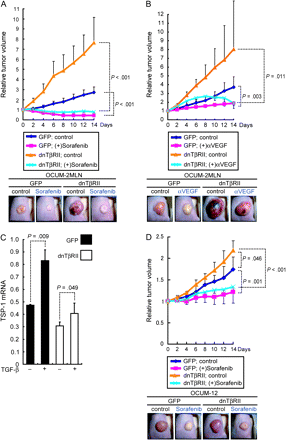 Administration of sorafenib and tumor growth in nude mice. A) Growth curve of xenografted 2MLN-GFP and 2MLN-dnTβRII tumors and sorafenib treatment. Mice bearing tumors were treated with 800 μg of sorafenib or with vehicle, as indicated, every day for 14 days (n = 6 mice per group). The representative macroscopic appearance of the tumors at day 7 is shown in the bottom panels. B) Growth curve of xenografted 2MLN-GFP and 2MLN-dnTβRII tumors in the presence and absence of anti-VEGF neutralizing antibody (n = 6 mice per group). Mice bearing tumors were treated for 14 days with 50 μg of anti-VEGF antibody or vehicle, as indicated, twice a week. The representative macroscopic appearance of the tumors at day 7 is shown in the bottom panels. C) Expression of human TSP-1 mRNA and treatment with TGF-β. TSP-1 mRNA expression was determined by quantitative real-time reverse transcription–polymerase chain reaction in the control OCUM-12-GFP (GFP) and OCUM-12-dnTβRII (dnTβRII) cells that were treated with TGF-β (1 ng/mL) or left untreated for 24 hours in vitro. The experiment was conducted two times, each sample was assessed in triplicate, and data were averaged. Data from one representative experiment of these are shown. D) Growth curves of xenografted OCUM-12-GFP and OCUM-12-dnTβRII tumors and sorafenib treatment. Mice bearing tumors were treated with 800 μg of sorafenib or with vehicle, as indicated, every day for 14 days (n = 7 mice per group). The representative macroscopic appearance of the tumors at day 14 is shown in the bottom panels. Error bars = 95% confidence intervals. P values for (A), (B), and (D) were calculated by two-way repeated measures analysis of variance. Those for (C) were calculated with a Student's t test, two-sided. DMSO = dimethyl sulfoxide (vehicle). dnTβRII = dominant-negative TGF-β type II receptor; GFP = green fluorescent protein; VEGF = vascular endothelial growth factor; TGF-β = transforming growth factor β; TSP-1 = thrombospondin-1.