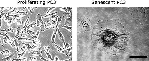  Proliferating and drug-induced senescent PC3 prostate cancer cells. Senescent cancer cells exhibit the characteristic morphology and increased SA-β-gal activity seen in replicative senescent cells. PC3 cells were cultured in drug-free medium or in medium containing 250 nM quinone diaziquone for 3 days followed by 2 days in drug-free medium ( 13 ), fixing, and staining ( 12 ). Cells were visualized under ×200 magnification using phase contrast microscopy. Scale bar = 100 μm; SA-β-gal = senescence-associated β-galactosidase. 