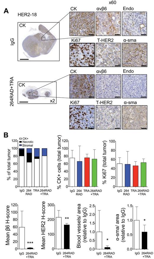 The effect of 264RAD in combination with trastuzumab on human xenograft MCF-7/HER2-18 tumor growth and stroma. A) Micrographs of MCF-7/HER2-18 tumor xenografts from mice treated with IgG, or 264RAD+TRA (10mg/kg; ip) twice weekly for two consecutive weeks (tumors harvested after two weeks treatment from Figure 4B). Tumors were harvested, fixed, parafin embedded, and sections subjected to immunohistochemical staining for the indicated molecules of interest including cytokeratin (CK, epithelial marker), Ki67 (proliferation), endomucin (vasculature), α-sma (myofibroblasts), as well as αvβ6 and HER2 expression. Representative images are shown of the three tumors harvested for IgG and the combination treatment, where the greatest effect was observed. Scale bar in whole tumor images = 2000 μM, magnified images (x60) are of indicated region of interest (CK+ cells). Scale bar in x60 magnification images = 20 μM. B) Bar graph of composition of xenografts (% CK+ cells = white bar, % necrotic area in black, and % stroma is in gray or blue) and histograms of specific marker expression of xenografts shown in (A). Assessed and scored by two individuals (n = 3 individual tumors, error bars represent 95% confidence interval). *P = .05, **P = .01, ***P < .001 (relative to IgG, as determined by two-sided, one-way analysis of variance with Bonferroni Multiple Comparison Test [B, upper panel] and two-sided Student’s t-test [B, lower panel]). CK = pancytokeratin; HER2 = Human Epidermal Growth Factor Receptor 2; IgG = immunoglobulin; TRA = trastuzumab.