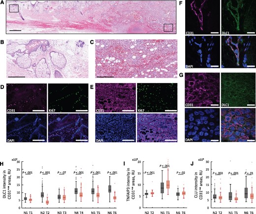 Deleted in Liver Cancer 1 (DLC1) in human angiosarcoma and normal endothelium. Histology of angiosarcoma section containing normal and tumor cells; hematoxylin and eosin staining (A); boxed areas magnified in ((B) normal) and ((C) tumor). CD31 and Ki67 immunostaining (D and E) shows that the normal CD31+ endothelial cells are mostly nonproliferative (some CD31- cells, likely gland-associated are Ki67+ in (D), whereas CD31+ tumor cells are Ki67+(E)). CD31+ normal endothelium is DLC1+(F); DLC1 levels in angiosarcoma (G). Quantitative analysis of DLC1 fluorescence intensity in CD31+ regions within areas of normal and tumor tissue in individual angiosarcoma tissue biopsy specimens (H). Quantitative analysis of TNFAIP3/A20 (I) and clusterin (J) fluorescence intensity in CD31+ regions of six individual biopsies from six patients, including normal and tumor areas. The box-and-whisker plots in (H and I) reflect the distribution of data points (box bottom: first quartile; box top: third quartile; horizontal line: median; whiskers: lowest and highest data points within 1.5 times the interquartile range). Statistical significance shown in (H–J) is from Mann-Whitney U test. Scale bars: A = 1 mm; B and C = 300 μm; D and E = 200 μm; F and G = 20 μm. CLU = clusterin; DLC1 = Deleted in Liver Cancer 1 (DLC1); N = normal; T = tumor.