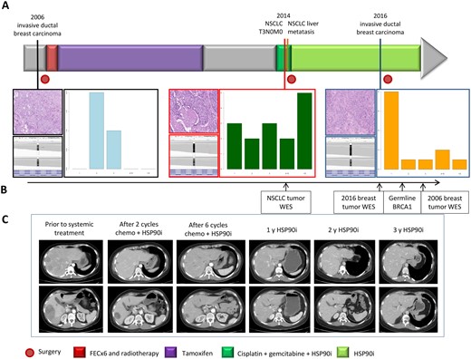Tumor sites and therapies timelines. A) In the upper section, timelines of the different tumors and treatments received. In the lower part, morphological appearance of the first invasive ductal breast carcinoma, lung tumor, and second breast cancer (hematoxylin and eosin, 20×); allelic expression of BRCA1 and patterns of insertions and deletions of indel length distribution in the three tumors through exome sequencing. B) Timing of genotypic analysis performed in different samples along the evolution of disease. C) Tumor response represented with computed tomography scans of the liver metastasis of non–small cell lung cancer at the time points indicated: previous systemic treatment, after two cycles of chemotherapy plus HSP90i, at the end of six cycles of chemotherapy, after 12 months with HSP90i, after 24 months with HSP90, and at 36 months with HSP90i. The scale bars are presented on the left of images, and each small bar represents 2 cm. FEC = fluorouracil, epirubicin, cyclophosphamide; WES = whole-exome sequencing.