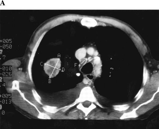 A) Computed tomography (CT) scan of the
thorax at the level of the carina on “soft-tissue” windows. Two
lesions have been measured with calipers. The intraparenchymal lesion
has been measured bidimensionally, using the greatest diameter and the
greatest perpendicular distance. Unidimensional measurements require
only the greatest diameter to be measured. The anterior-carinal lymph
node has been measured using unidimensional criteria. B) The
same image as above imaged on “lung” windows, with
the calipers remaining as they were for the soft-tissue measurements.
The size of the lung lesion appears different. The anterior-carinal
lymph node cannot be measured on these windows. The same windows should
be used on subsequent examinations to measure any lesions. Some favor
soft-tissue windows, so paratracheal, anterior, and subcarinal lesions
may be followed on the same settings as intraparenchymal lesions.
