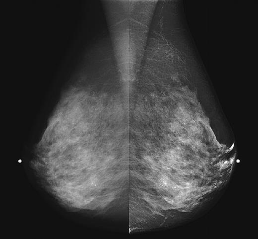 Shown above are two versions of the same left medial oblique mammogram obtained with a scanned-slot digital mammography system. On the left, the digital image has been displayed to approximate the normal contrast level of a modern film mammogram. On the right, the digital image has been processed to equalize the image for changes in breast thickness at the periphery. This provides good contrast throughout the image.