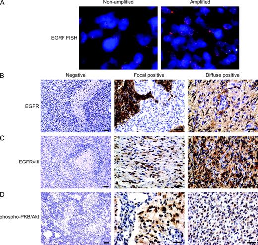  Status of epithelial growth factor receptor (EGFR) and phosphorylated protein kinase B (PKB)/Akt in gliomas. ( A ) Fluorescence in situ hybridization analyses of EGFR-nonamplified tumor and EGFR-amplified tumor. Representative sections of both types of tumors are shown. ( B–D ) Immunohistochemical analyses of EGFR, EGFRvIII, and phosphorylated PKB/Akt. The composite panel shows negative, focal positive, and diffuse positive staining for the three antibodies, as indicated. The negative staining images are presented at ×100 original magnification to demonstrate absent staining in tumor cells. Focal and diffuse staining images are presented at ×400 original magnification to demonstrate the staining detail in tumor cells. Antibodies for EGFR and EGFRvIII exhibit membranous and cytoplasmic staining, as previously reported  ( 18 )  . Representative sections of a negative, a focally positive, and a diffusely positive tumor, respectively, are shown. In panels A–D, scale bars = 20 μm. 