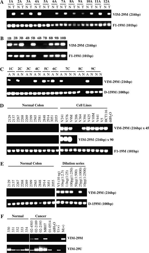  Methylation-specific polymerase chain reaction (MS-PCR) detection of vimentin gene methylation in colonic neoplasia. A ) Results of MS-PCR with primer set 29 to detect vimentin gene methylation in 12 colon cancers (T) versus matched normal colon mucosa (N) from the same case patients. The upper panel shows detection of the 216-bp reaction product specific for a methylated vimentin template (VIM-29M). The lower panel shows, as a positive control, MS-PCR detection in each of these samples of a constitutively methylated domain on chromosome 16, as indicated by the 101-bp reaction product, designated F1-19M. B ) Results of MS-PCR with primer set 29 to detect vimentin gene methylation in a cohort of 10 advanced colon adenomas, of size equal or greater than 1 cm. C ) Results of MS-PCR with primer set 29 to detect vimentin gene methylation in a cohort of nine aberrant crypt foci (A) from six different individuals compared with histologically normal mucosa from the same person (N). The lower panel shows detection in these samples of a control constitutively methylated domain on chromosome 10 as indicated by the 100-bp reaction product designated D-159M. D ) Evaluation of the technical performance of vimentin MS-PCR primer set 29. The upper panel shows detection of vimentin methylation by amplification of the 216-bp reaction product specific for methylated vimentin (VIM-29M). Amplifications were performed for 45 cycles. The middle panel shows results of transferring an aliquot of the above reactions to a fresh 45-cycle PCR. The lower panel shows MS-PCR detection in all samples of a constitutively methylated domain F1-19M (positive control). Numbers denote sample numbers of colon cancer cell lines and normal colon tissues. E ) Detection of vimentin methylation by MS-PCR primer set 29 in 10 ng of genomic DNA from colon cancer cell line Vaco5 (V5) and in a series of dilutions of Vaco5 genomic DNA into control, unmethylated normal colon DNA. Reactions contain 25 ng of control unmethylated DNA from normal colon and from 10 ng to 10 pg of methylated Vaco5 DNA. Numbers indicate the amount of methylated Vaco5 DNA and the ratio of Vaco5 DNA relative to the total DNA in each reaction. The lower panel shows detection in all the samples of a constitutively methylated domain D-159M (positive control). F ) Detection of vimentin methylation in fecal DNA analyzed by MS-PCR primer set 29. The upper panel (VIM-29M) shows assay of vimentin gene methylation in fecal DNA samples from five normal and five colon cancer patients. The lower panel (VIM-29U) shows control amplification in all samples of wild-type unmethylated vimentin sequences derived from normal cells. Additional assay controls include a negative water blank and control methylated (M+) and unmethylated (U+) vimentin DNA samples. 