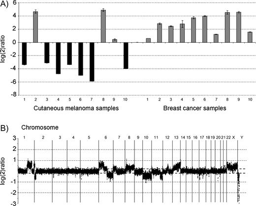  RASEF expression levels in sporadic cutaneous malignant melanomas (CMMs) and breast cancer tissue, and genomic profile of a sporadic CMM patient by comparative genomic hybridization (CGH). A ) RASEF expression levels in sporadic CMM tissue (n = 10) and breast cancer tissue (n = 10) samples (obtained from the tissue bank of Department of Oncology, Lund University) as measured by quantitative real-time polymerase chain reaction (PCR). Expression of RASEF was normalized to ribosomal RNA subunit 18S in each sample according to the ΔCt method  ( 24 )  and compared with the normalized RASEF expression in Stratagene Universal Reference RNA (consisting of a pool of RNA from 10 different cell lines, including breast cancer, hepatoblastoma, cervical cancer, testicular embryonal carcinoma, glioblastoma, melanoma, liposarcoma, histiocytic lymphoma, lymphoblastic leukemia, and plasmacytoma, for broad gene coverage; Stratagene Corporation, La Jolla, CA) resulting in log 2 ratios ( y axis). The following protocols were used: Total RNA was extracted with Trizol (Invitrogen, Paisley, UK) reagent followed by RNeasy Midi purification kit (Qiagen, Crawley UK), quantified in spectrophotometer at 260 nm and tested for integrity in an Agilent Bioanalyzer (Agilent Technologies, Palo Alto, CA). Reverse transcription was carried out in a 20-μL volume using Superscript II with 2 μg of total RNA. Real-time PCR was performed in a Rotorgene (Corbett Research, Sydney, Australia) apparatus using Quantitect SYBR Green (Qiagen, Crawley, UK) master mix and the following primers: RASEF_F GAGGAAGCCCTCAGTGACCT; RASEF_R ATGCAGCCACATCTTCCTTT; 18S_F CGGCTACCACATCCAAGGAA; and 18S_R GCTGGAATTACC GCGGCT, designed using Primer3 software ( http://frodo.wi.mit.edu/cgi-bin/primer3/primer3_www.cgi ). B ) The genomic profile of a sporadic CMM patient, as determined by CGH analysis on a 32K BAC array. Gains were observed on chromosomes 1q, 6p, 8, 12, 13, and losses were noted on 2p, 6q, 10, 11q, and on other chromosomes. However, no copy number changes were seen on chromosome 9. High-resolution microarrays were produced from the 32K BAC clone library (CHORI BACPAC Resources; http://bacpac.chori.org/genomicRearrays.php ), which included a total of 32 433 clones (∼1240 clones from chromosome 9), providing a tiling coverage at an average 45-kb resolution over the genome. DOP–PCR products from the BAC DNA template were purified using 96-well filter plates, dried, and resuspended in 50% dimethyl sulfoxide to a concentration of 500–1000 ng/μL. Arrays were printed on UltraGAPS slides (Corning, NY) using a MicroGrid II spotter (Biorobotics, Cambridge, UK) as described in detail elsewhere (Jönsson et al., submitted 2005). One microgram of genomic DNA was labeled using random labeling (Invitrogen, Paisley, UK). Test DNA and male reference DNA were differentially labeled, pooled, mixed with human COT-1 DNA, dried down, and resuspended in a formamide-based buffer. Slides were hybridized under cover slips for 48–72 hours at 37 °C, washed  ( 25 )  , and scanned (Agilent Technologies). Image analysis was done with Gene Pix Pro 4.0 software (Axon Instruments; Molecular Devices Corporation, Union City, CA) and data further analyzed with Bio Array Software Environment BASE (developed at Lund University)  ( 26 )  . Background correction of Cy3 and Cy5 intensities was calculated using the median-feature and median-local background intensities provided in the quantified data matrix. Within arrays, intensity ratios for individual probes were calculated as background-corrected intensity of tumor sample divided by background-corrected intensity of reference sample. Signal-to-noise filters of at least 10 for the sample channel and at least 10 for the reference channel were applied to the data, and spots that failed to meet these criteria were excluded from further analysis and regarded as missing values. The filtered data were, for each array separately, centralized to a median ratio of unity. All filtering, normalization, and analysis was performed in BASE  ( 26 )  . A moving median sliding window of three clones was used, and each clone was designated a new ratio value. Cutoff ratios for gains and losses were set to log 2 ratio of ±0.2. 