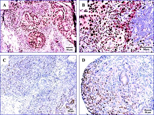  Immunohistochemical staining for proliferating cell nuclear antigen (PCNA). ( A ) Tumor from the omentum of a no-treatment mouse (i.e., a mouse that was injected with tumor cells but not treated); ( B ) lymph nodes from a no-treatment mouse; tumors from the pelvis ( C ) and mesentery ( D ) of a mouse treated with PDT + C225 resected 72 hours after the second PDT treatment. The blue color indicates nuclear staining and the brown color represents staining for PCNA. Magnification bars represent 50 μm. 