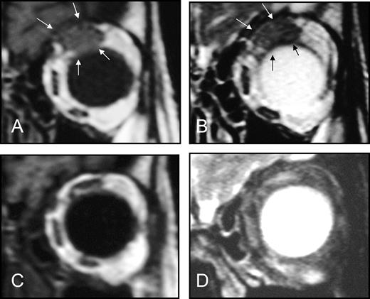  Effect of 3-week doxycycline therapy in an 85-year-old woman with ocular adnexal MALT lymphoma that was negative for Chlamydia psittaci DNA. The patient had experienced a relapse after chlorambucil and left orbit irradiation. Magnetic resonance imaging performed 2 weeks before doxycycline therapy showing in coronal T1-weighted ( A ) and T2-weighted ( B ) images (3-mm-thick slices) a neoplastic lesion in the left orbit that had infiltrated the superior rectum muscle ( bordered by arrows ). Coronal T1W ( C ) and T2W ( D ) magnetic resonance examination (3-mm-thick slices) performed 3 months after conclusion of doxycycline treatment showing a complete remission of the neoplastic lesion in the left orbit. 