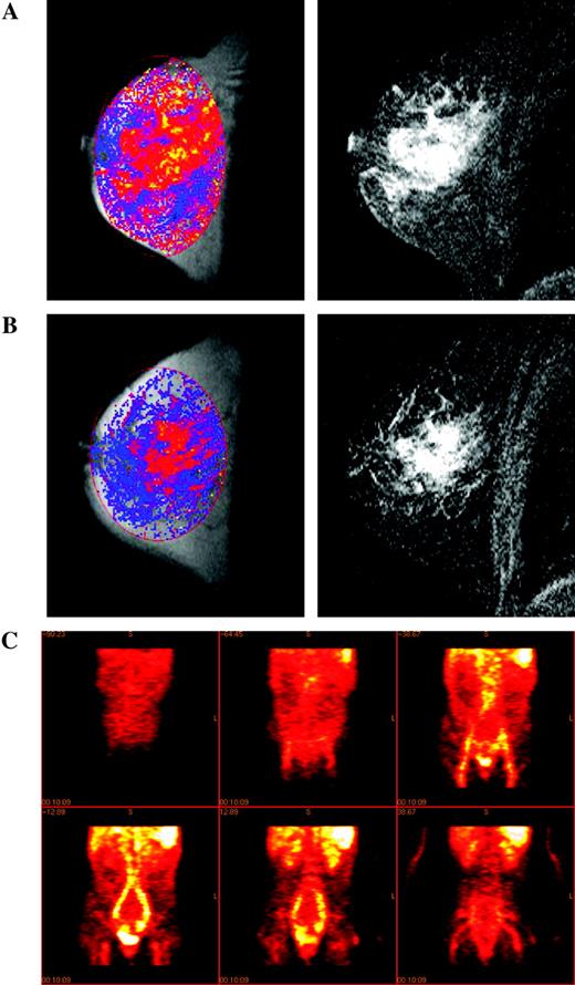  Measuring angiogenic and vascular change. Magnetic resonance images of a grade 2 infiltrating lobular breast cancer in a 49-year-old patient before ( A ) and after ( B ) treatment with cyclophosphamide and doxorubicin. Left panels : images of Ktrans scaled to a maximum of 1 min −1 where Ktrans is displayed using a color scale in which low values are dark blue and high values are yellow (absence of color indicates no value fitted); right panels : two-dimensional gradient echo subtraction images showing areas of contrast enhancement in white. Courtesy of Dr. A. Padhani, The Institute of Cancer Research and Royal Marsden Hospital. C ) Coronal sections showing the distribution of 124 I-labeled anti-vascular endothelial growth factor (VEGF) receptor antibody (low uptake, dark red ; high uptake, white ) given concurrently with the phase I treatment in a patient with metastatic colorectal cancer (imaging at 24 hours after treatment). Reproduced by permission of Oxford University Press from Jayson et al.  ( 134 )  . 