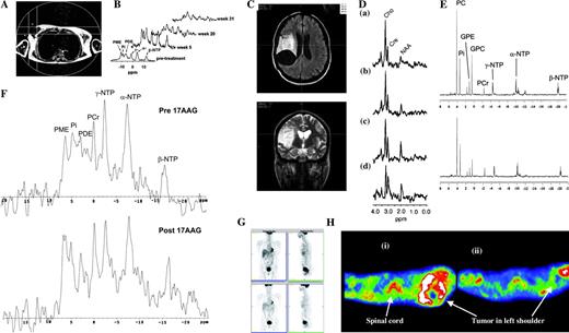  Assessing response via metabolic change. A ) Localization image for 31 P magnetic resonance spectroscopy showing a single voxel positioned over a breast tumor. B ) 31 P magnetic resonance spectra obtained from the region defined in A before (pretreatment), during (week 5 and week 20), and after (week 31) a course of chemotherapy, showing an initial increase in all metabolites (week 3) followed by a marked reduction in metabolite signals with treatment (weeks 20 and 31). Reproduced with permission from Leach et al.  ( 77 )  , copyright John Wiley and Sons Limited. C ) Pretreatment fluid-attenuated inversion recovery ( top ) and T2-weighted fast spin-echo ( bottom ) images from a patient with low-grade glioma receiving treatment for recurrent disease, showing the position of voxels selected for spectroscopy. D ) Serial 1 H spectroscopy measurements from the same patient showing long echo time (TE =135 ms) stimulated-echo acquisition mode spectra obtained before ( a ) and at ( b ) 3 months, ( c ) 6 months, and ( d ) 9 months after initiation of temozolomide treatment. Within both series, a progressive decrease in the choline/creatine (Cho/Cre) ratio was observed, suggesting reduced membrane metabolism and diminishing cellular density. Also note the increasing conspicuity of the N-acetylaspartate (NAA) peak, a specific neuronal marker whose level may reflect the regression of tumoral tissue and repopulation of normal brain matter. First published in Murphy et al.  ( 83 )  . E ) In vitro 31 P magnetic resonance spectra of cell extracts obtained from human colon adenocarcinoma HT29 cells treated with the Hsp90 molecular chaperone inhibitor 17-allylamino,17-demethoxygeldanamycin (17AAG) ( top ) or with vehicle ( bottom ). F ) In vivo 31 P magnetic resonance spectra of a HT29 tumor xenograft before ( top ) and after ( bottom ) 17AAG treatment. Reproduced by permission of Oxford University Press from Chung et al.  ( 106 )  . G ) Fluorodeoxyglucose positron emission tomography (FDG PET) images of a patient before ( top panels ) and 8 hours after ( bottom panels ) imatinib treatment ( left panels: coronal view; right panels: sagittal view) showing two rectal gastrointestinal stromal tumors behind the bladder and a liver metastasis. All tumors showed reduced uptake of tracer at 8 hours. Courtesy of Dr. H. Minn, University of Turku, Finland; reproduced by permission of Taylor & Francis Ltd. (http://www.tandf.co.uk/journals) from Joensuu et al.  ( 123 )  . H ) [ 11 C]Thymidine scans of a patient with Ewing's sarcoma ( i ) before and ( ii ) after combination chemotherapy. The white areas indicate regions of highest tracer uptake. Combination chemotherapy resulted in decreased uptake of radiolabel. Resection revealed almost complete histologic response. Redrawn from Gupta et al.  ( 111 )  , reprinted with permission from Elsevier. GPC = glycerophosphocholine; GPE = glycerophosphoethanolamine; PC = phosphocholine; PCr = phosphocreatine; PME = phosphomonoester; Pi = inorganic phosphate; ppm = chemical shift in parts per million; NTP = nucleoside triphosphate. 