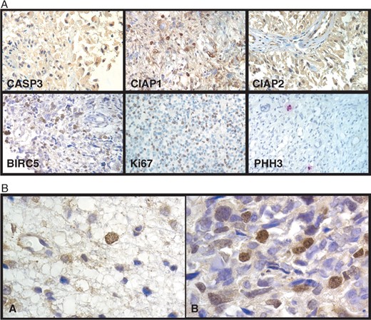 (A) Representative immunostaining of CASP3, CIAP1, CIAP2, BIRC5, Ki67, and PHH3 in diffusely infiltrating astrocytomas. Horseradish peroxidase (for first 5 markers with diaminobenzidine as chromogen) or alkaline phosphatase (for PHH3 with AP red [Zymed, San Francisco, CA] as chromogen) labeled streptavidin-biotin immunostaining with hematoxylin counterstain. Original magnification for each panel: 400×. (B) BIRC5 nuclear labeling in astrocytomas. (A) Single nuclear positive cell in a diffuse astrocytoma. (B) High percentage of BIRC5 nuclear labeling in a glioblastoma multiforme. Horseradish peroxidase labeled streptavidin-biotin immunostaining with hematoxylin counterstain. Original magnification for each panel: 1,000×.