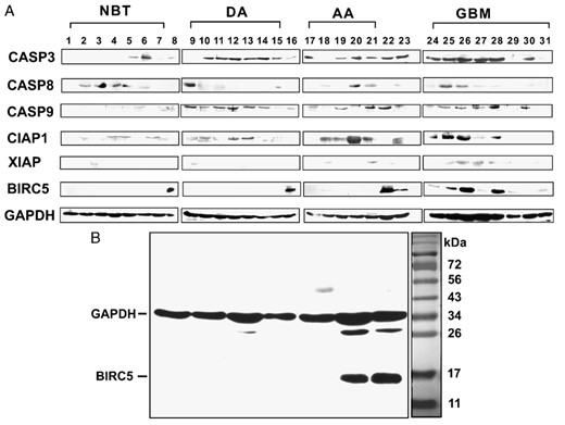 (A) Western blot analysis of caspases and inhibitor of apoptosis proteins in normal brain tissue (NBT, lanes 1-7), diffuse astrocytoma (lanes 9-15), anaplastic astrocytoma (lanes 17-21), and glioblastoma multiforme (lanes 24-31). Controls included glioma cell line U251 (lanes 8 and 22), melanoma cell line A875 (lane 16), and a carcinoma tissue sample (lane 23), which were known to express BIRC5 and caspase 3. GAPDH was used as internal control. (B) Western blot analysis of BIRC5 in one original blot. Simultaneous probing of BIRC5 and GAPDH illustrate the specificity of the antibodies. Absence of BIRC5 (first 5 lanes from left) in 5 astrocytoma samples and presence of BIRC5 in glioma cell U251 (lane 6) and a carcinoma sample (lane 7). A prestained broad-range (11-170 kDa) protein ladder was used for SDS-PAGE and aligned to the blot on the right.