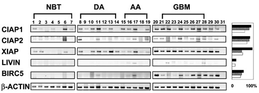 Reverse transcriptase- polymerase chain reaction (RT-PCR) analysis of inhibitor of apoptosis protein (IAP) mRNA in normal brain tissue (lanes 1-7), diffuse astrocytoma (lanes 8-14), anaplastic astrocytoma (lanes 15-19), and glioblastoma multiforme (lanes 21-28). Controls included glioma cell line U251 (lane 20), melanoma cell line SK-mel-1 (lane 29), and a carcinoma tissue sample (lane 30), which were known to express BIRC5. Lane 31 was a blank control (no templates). The bar chart on the right side represented comparison of positivity rates (%) of IAPs in the astrocytoma samples assessed by RT-PCR (black bars), Western blot (gray bars), and immunohistochemistry (IHC) (white bars). The rates for RT-PCR and Western blotting were based on the 20 fresh astrocytoma samples, whereas that for IHC was based on the staining results of the 78 astrocytoma samples. An IHC score of 1 or greater was counted as positive.