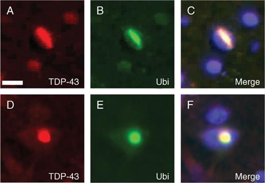 Double labeling of inclusion body myopathy associated with Paget disease of bone and frontotemporal dementia (IBMPFD) inclusions with TAR DNA binding protein 43 (TDP-43) and ubiquitin. (A-F) Double label immunofluorescence with anti-TDP-43 (red) and anti-ubiquitin (Ubi) (green) demonstrates colocalization of both proteins in the pathologic inclusions in IBMPFD brains. Scale bar = (A) 10 μm.