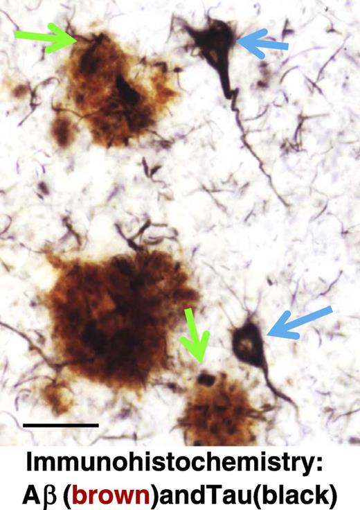 Photomicrograph of a section from the cerebral neocortex of an Alzheimer disease brain stained using double-label immunohistochemistry for β-amyloid (Aβ, reddish brown) and microtubule-associated protein tau (black). Aβ plaques (AβPs; blue arrows) are roughly spherical and extracellular, whereas neurofibrillary tangles (NFTs; green arrows) develop within neurons. Note that some of the dystrophic neurites in the AβPs contain aberrant tau protein pathology (black), which is biochemically identical to that seen in intracellular NFTs. These Aβ1Ps have been described to be “neuritic plaques.” Scale bar = 50 μm.