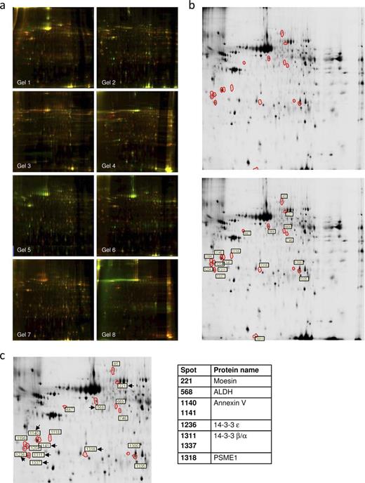  Proteomic discovery-phase study of choroid plexus proteins associated with Alzheimer disease (AD)–related pathology. ( A ) Two-dimensional difference gel electrophoresis (2D-DIGE) analysis gel images with superposition of Cy3 and Cy5 dyes, corresponding with pairing a control sample and a sample from patients with AD-related pathology. ( B ) Images representing choroid plexus protein expression on 2D gels from control subjects (top panel) and AD (bottom panel). Differently regulated spots are surrounded by red borders, and spot numbers are highlighted by white boxes. ( C ) Zoomed area with the selected spots is shown. Proteomic identification of choroid plexus proteins associated with AD progression is present on the right. 