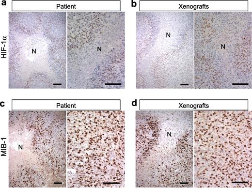  Perinecrotic neoplastic cells express HIF-1α and are proliferative in the MGG123 model and the patient GBM. (A, B) HIF-1α immunostaining shows HIF-1α expression (brown) in cells surrounding necrotic foci [N] in both the xenograft and patient tumor. (C, D) MIB-1 is highly expressed in perinecrotic areas as well as other viable tumor areas in both xenografts and patient tumor (labeling index 48% and 44%, respectively). Scale bar = 100 μm. 