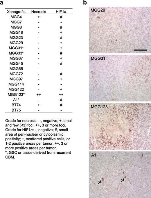  HIF-1α and necrosis status in a cohort of patient-derived orthotopic GBM xenografts. (A) Summary of the status of necrosis and HIF-1α IHC in 19 patient-derived orthotopic GBM xenografts. (B) Examples of HIF-1α IHC on orthotopic GBM xenografts. Some tumors contain a small number of cells that exhibit HIF-1α staining in the perinuclear areas or cytoplasm (arrows). Scale bar = 100 μm. 