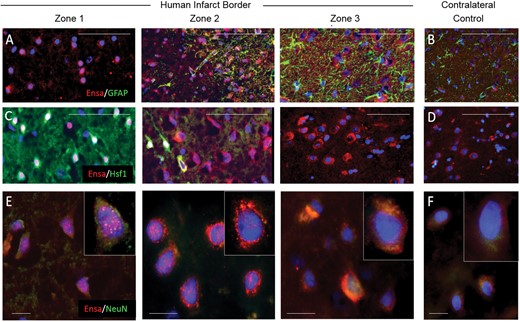 Upregulation and nuclear translocation of αEnsa protein is detected in ischemic human neurons using a polyclonal rabbit-anti-αEnsa primary antibody. Immunofluorescent montage images of ischemic human cortex reveal αEnsa protein expression changes in distinct regions of infarcted brain (A, C), relative to controls (B, D). Double label immunofluorescent images demonstrate colocalization with NeuN in degenerating ischemic neurons, with punctate labeling and nuclear translocation seen in zones 1 and 2 (data are representatiave of findings in 5 postmortem cerebral infarcts); original magnification, 20× (A–D); 40× (E, F); scale bars, 50 µm (A–D) or 10 µm (E, F); αEnsa, red/CY3; GFAP, Hsf1, NeuN, green/FITC; nuclei, blue/DAPI.