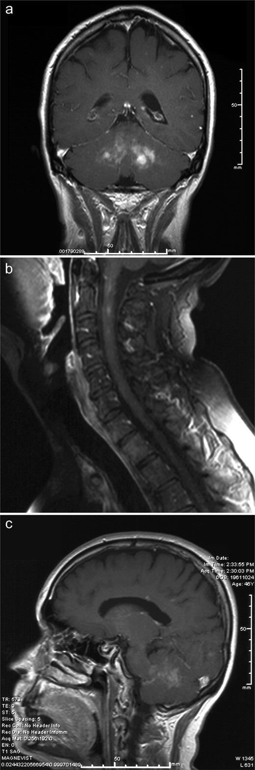 Case 1. (A) T1-weighted coronal magnetic resonance imaging (MRI) with gadolinium illustrates the bilateral enhancing cerebellar lesions with epicenters near the dentate nuclei. (B) T1-weighted sagittal MRI with gadolinium of the spine shows patchy, somewhat linear enhancement in the upper cervical cord, without cord expansion. (C) T1-weighted sagittal MRI with gadolinium reveals increased signal in the infundibular stalk and posterior pituitary gland, which can be seen in patients with ECD even if diabetes insipidus is not clinically evident. Posterior fossa lesions in this patient are also seen well on this sagittal image.