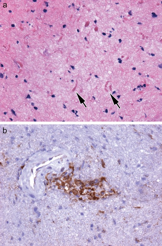 Case 1. (A, B) The nondiagnostic biopsy showed prominent piloid gliosis with profuse numbers of Rosenthal fibers (arrows, A) not accompanied by neoplastic piloid tumor cells. Small collections of cytologically bland, CD68-immunopositive histiocytes are less conspicuous (B).