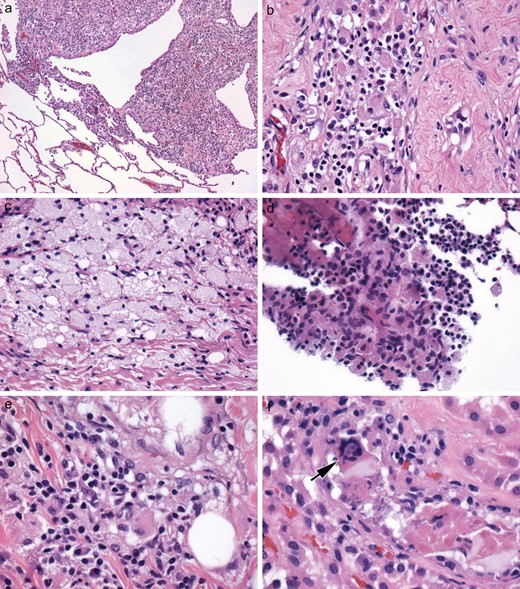 Case 1. (A–F) The diagnosis of ECD was made only at autopsy, based on the much more striking brain findings than in the biopsy. Interestingly, histiocytic collections in systemic organs had been overlooked by the general pathologist but on retrospective review, non-CNS organs were clearly affected by ECD, yielding small multifocal nodular histiocytic collections in the lung (A), histiocytes with eosinophilic cytoplasm in the testis (B), and foamy histiocytes in the parathyroid (C). Bone marrow was focally involved, even if not clinically apparent (D); and in a few locations, the numbers of other types of mononuclear inflammatory cells exceeded that of the histiocytes, as in the kidney (E). Touton giant cells (arrow), a characteristic finding in ECD when present, were quite rare; this one was identified in the kidney, however (F).