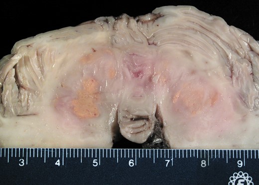 Case 1. The most striking gross finding at autopsy was multifocal bright yellow histiocytic deposits in bilateral cerebellar hemispheres, encompassing the dentate nuclei. Compare with premortem neuroimaging in Figure 1A, C.