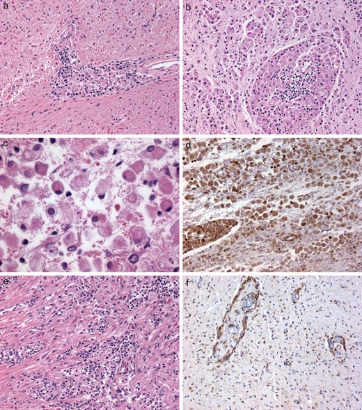 Case 1. (A–F) Cerebellum at autopsy demonstrated numerous Rosenthal fibers in surrounding gliotic brain tissue but there were more prominent perivascular histiocytic collections (A, B), as well as diffuse parenchymal histiocytic infiltrates (B). A range of morphological features was seen within a single aggregate of the ECD histiocytes, with some showing mild foamy cytoplasmic features and others showing completely eosinophilic cytoplasm (C). The rounded cytoplasmic profiles distinguished these from stellate, reactive gemistocytic astrocytes, as did CD68 immunoreactivity (D). Histiocytic collections were identified in the hypothalamus, another frequently involved anatomical CNS site in ECD (E). Although lesions had been identified on premortem imaging in the spinal cord (see Fig. 1B), even at autopsy many areas of involvement were subtle, as seen with anti-CD68 immunohistochemistry (F). As in the premortem biopsy, such areas were clearly abnormal but not fully and specifically diagnostic for ECD without corroborating the lesion with findings in other areas in the same brain (A–E).