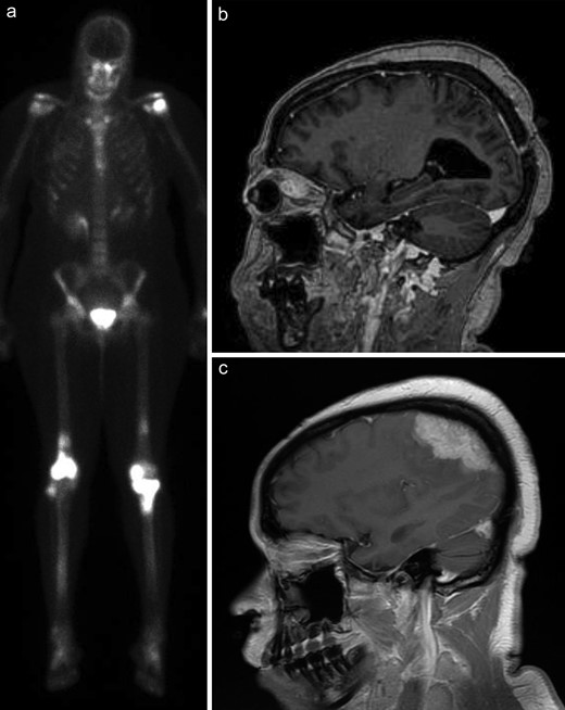 Case 3. (A) One year after presentation, the patient underwent nuclear medicine bone scans that showed bilateral increased uptake in the distal femur, proximal tibia, and humeral head. (B) Five years later, she developed eye fullness and visual changes that prompted an MRI scan (sagittal, T-weighted, with contrast), which demonstrated a left intraconal mass intimately associated with the ocular musculature. (C) Six years later, new neurological symptoms prompted another MRI scan that showed an enhancing convexity dural mass.