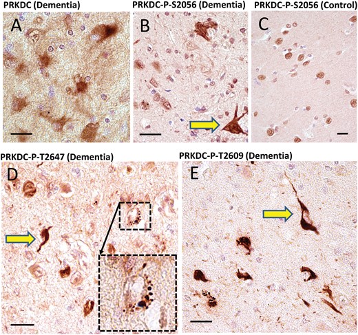 Immunohistochemistry for PRKDC in human brains using 4 separate antisera. Among all the candidate novel DIPPs, the strongest immunohistochemical staining was found using antisera against PRKDC. The antiserum raised against nonphosphorylated PRKDC provided relatively indistinct staining of cellular features, and high background (A). By contrast, all 3 antisera raised against phosphorylated epitopes within PRKDC showed immunostaining of what appeared to be clear-cut inclusion bodies: anti-PRKDC-P (S2056) (B, C); anti-PRKDC-P (T2647) (D); and anti-PRKDC-P (T2609) (E). These results are representative of a tendency to stain inclusion bodies (yellow arrows) in dementia cases. By contrast, nondemented cases showed no inclusion body-like structures, and generally immunostained nuclear profiles, as expected (C). In addition to immunostaining inclusion body-like structures, the anti-PRKDC-P antisera also highlighted roundish cytoplasmic structures in cognitively impaired subjects, such as the one in the inset in panel D. Note also the presence of neuropil thread-like staining (E). Scale bars: A–E = 20 μm.