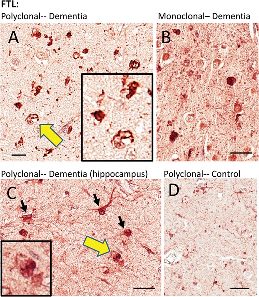 Immunohistochemistry for FTL in human brains. Two different FTL antibodies were used and they showed similar results. A goat polyclonal antiserum (A, C, D) highlighted immunostained structures with astrocyte and microglial features, as well as what looked like intracellular inclusions. A mouse monoclonal anti-FTL antibody (B) showed similar changes as the polyclonal antiserum. Areas indicated with the yellow arrows are shown at higher magnification (insets), depicting FTL immunostained structures with histomorphologic features of inclusion bodies. The cell types stained by the FTL antibodies, even in diseased brains, appeared mostly nonneuronal. Hippocampus from 1 brain with HS-Aging/CARTS was stained (92-year-old at death; (C) to allow better discrimination of cell types, and showed both glial and neuronal (inset) immunostaining. In brains of nondemented subjects (D), FTL antibodies showed relatively sparse staining of cells with quiescent-type microglial and astrocyte morphology. Scale bars: A = 15 μm; B, C = 30 μm; D = 60 μm.