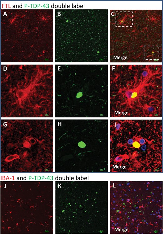 Double-label immunofluorescence: FTL and P-TDP-43. In double-label immunofluorescence experiments, FTL (red) and P-TDP-43 (green) signal overlapped (A–I). Note that the overlap between FTL and P-TDP-43 is only partial – some FTL and some P-TDP-43 signals are not colocalized. Panels D–F and G–I are higher-powered photomicrographs related to the areas of panels A–C that are boxed in panel C. Panels D–F depict a P-TDP-43 immunoreactive inclusion within a large and ramified FTL-immunopositive cell. Panels G–-I depict a P-TDP-43-immunoreactive structure that appears not to be within a cell in the plane of section, but is colocalized with FTL immunoreactivity. As expected from brightfield immunohistochemical experiments (Fig. 4), some noncolocalizing FTL label is present in cells with a microglial morphology. By contrast, when IBA-1 (a different microglial marker, labeled red) and P-TDP-43 (green) antibodies are used (J–L), there does not appear to be any colocalization. Scale bars: A–C, J–L = 15 μm; D–I = 5 μm.
